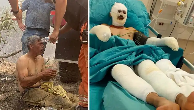 Yanıyorum Diyerek Feryat Eden Orman İşçisinin Tedavisi Devam Ediyor